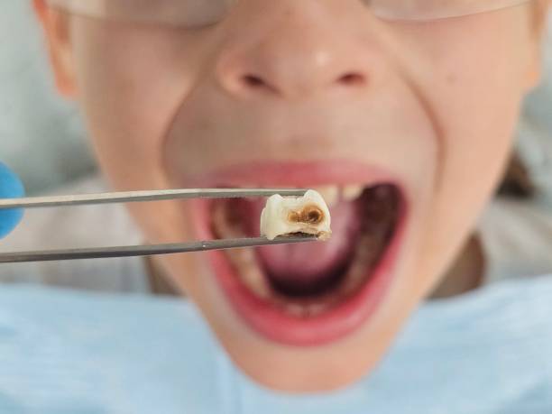 Best Dentist for Tooth Abscess  in South Elgin, IL